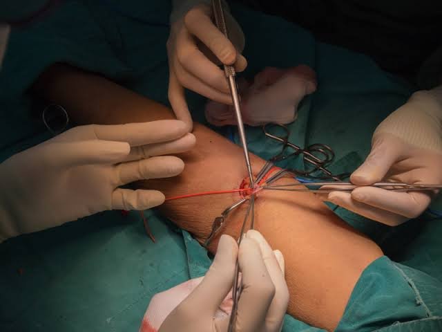 How to Choose the Right Surgeon for AV Fistula Surgery Av Fistula Surgery In Vadodara